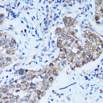 CASP3 / Caspase 3 Antibody - Immunohistochemistry of paraffin-embedded human lung cancer using CASP3 antibody at dilution of 1:100 (40x lens).