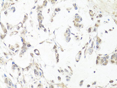 CASP3 / Caspase 3 Antibody - Immunohistochemistry of paraffin-embedded human gastric cancer using CASP3 antibody at dilution of 1:100 (40x lens).