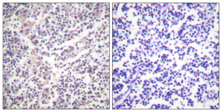 CASP3 / Caspase 3 Antibody - Immunohistochemistry analysis of paraffin-embedded human lymph node, using Caspase 3 (Phospho-Ser150) Antibody. The picture on the right is blocked with the phospho peptide.