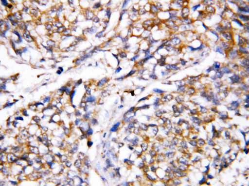 CASP4 / Caspase 4 Antibody - CASP4 / Caspase 4 antibody. IHC(P): Human Breast Cancer Tissue.