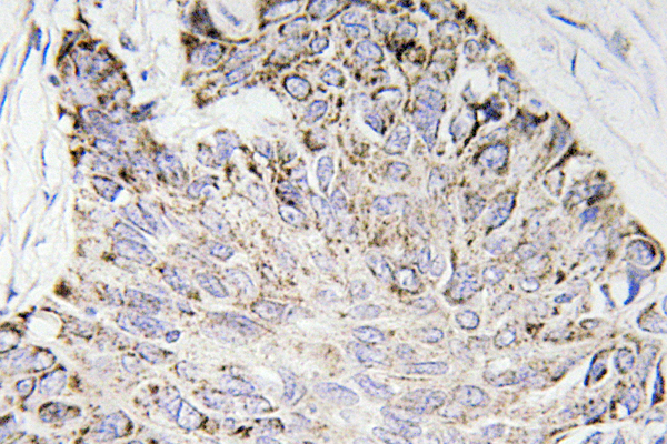 CASP4 / Caspase 4 Antibody - Immunohistochemistry analysis of Caspase-4 antibody in paraffin-embedded human lung carcinoma tissue.