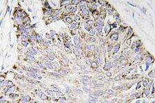 CASP4 / Caspase 4 Antibody - IHC of Caspase-4 (E124) pAb in paraffin-embedded human lung carcinoma tissue.