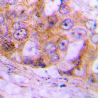 CASP4 / Caspase 4 Antibody - Immunohistochemical analysis of Caspase 4 staining in human lung cancer formalin fixed paraffin embedded tissue section. The section was pre-treated using heat mediated antigen retrieval with sodium citrate buffer (pH 6.0). The section was then incubated with the antibody at room temperature and detected using an HRP conjugated compact polymer system. DAB was used as the chromogen. The section was then counterstained with hematoxylin and mounted with DPX.