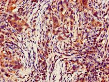 CASP4 / Caspase 4 Antibody - Immunohistochemistry of paraffin-embedded human pancreatic cancer using CASP4 Antibody at dilution of 1:100