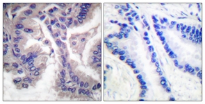 CASP6 / Caspase 6 Antibody - IHC of paraffin-embedded human lung carcinoma tissue, using Caspase 6 (Cleaved-Asp162) Antibody. The picture on the right is treated with the synthesized peptide.