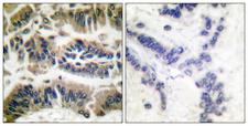 CASP6 / Caspase 6 Antibody - Immunohistochemistry analysis of paraffin-embedded human breast carcinoma tissue, using Caspase 6 Antibody. The picture on the right is blocked with the synthesized peptide.