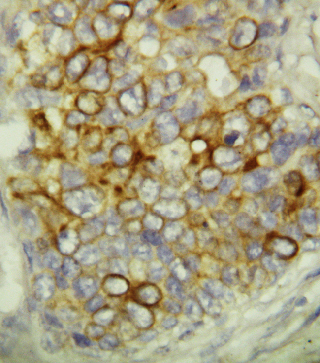 CASP6 / Caspase 6 Antibody - CASP6 / Caspase 6 antibody. IHC(P): Human Breast Cancer Tissue.