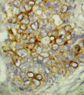 CASP6 / Caspase 6 Antibody - CASP6 / Caspase 6 antibody. IHC(P): Human Breast Cancer Tissue.