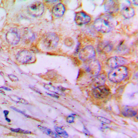 CASP6 / Caspase 6 Antibody - Immunohistochemical analysis of Caspase 6 p18 staining in human lung cancer formalin fixed paraffin embedded tissue section. The section was pre-treated using heat mediated antigen retrieval with sodium citrate buffer (pH 6.0). The section was then incubated with the antibody at room temperature and detected using an HRP conjugated compact polymer system. DAB was used as the chromogen. The section was then counterstained with hematoxylin and mounted with DPX.
