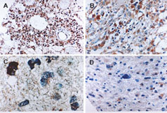 CASP6 / Caspase 6 Antibody - Formalin-fixed paraffin-embedded tissue sections of human gliomas stained for Active/Cleaved Caspase-6 expression using Caspase-6 antibody at 1:2000. Gemistocytoma (low grade tumor) at low (A) and high (B) magnification. Two examples of anaplastic, high grade (III) infiltrating gliomas (C and D). Increased active/cleaved Caspase-6 may be seen in high grade, compared to low grade tumors. Hematoxylin-Eos in counterstain.