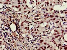 CASP6 / Caspase 6 Antibody - Immunohistochemistry of paraffin-embedded human lung cancer at dilution of 1:100