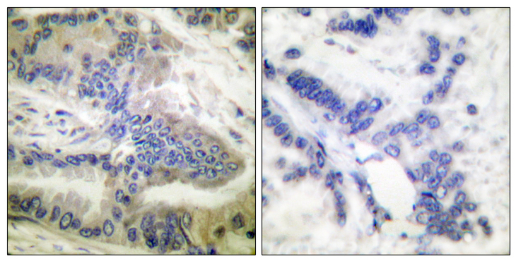 CASP6 / Caspase 6 Antibody - Immunohistochemistry analysis of paraffin-embedded human colon carcinoma, using Caspase 6 (Phospho-Ser257) Antibody. The picture on the right is blocked with the phospho peptide.
