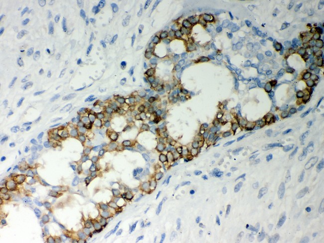 CASP7 / Caspase 7 Antibody - Caspase-7 antibody IHC-paraffin: Human Mammary Cancer Tissue.