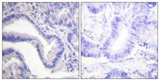 CASP7 / Caspase 7 Antibody - IHC of paraffin-embedded human lung carcinoma tissue, using Caspase 7 (Cleaved-Asp198) Antibody. The picture on the right is treated with the synthesized peptide.