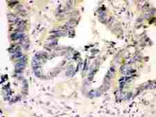 CASP7 / Caspase 7 Antibody - Anti-Caspase-7(P11) antibody, IHC(P): Human Intestinal Cancer Tissue