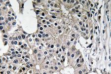 CASP7 / Caspase 7 Antibody - Immunohistochemistry analysis of Caspase-7 antibody in paraffin-embedded human breast carcinoma tissue.