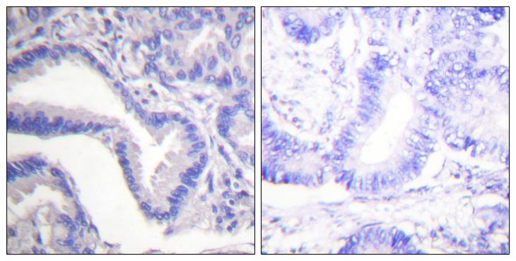 CASP7 / Caspase 7 Antibody - Cl-peptide - + Immunohistochemical analysis of paraffin-embedded human lung carcinoma tissue using Caspase 7 (Cleaved-Asp198) Antibody .