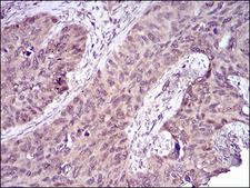 CASP7 / Caspase 7 Antibody - Immunohistochemical analysis of paraffin-embedded cervical cancer tissues using CASP-7 mouse mAb with DAB staining.