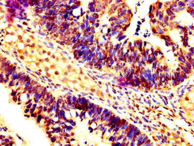 CASP7 / Caspase 7 Antibody - IHC image of CASP7 Antibody diluted at 1:200 and staining in paraffin-embedded human ovarian cancer performed on a Leica BondTM system. After dewaxing and hydration, antigen retrieval was mediated by high pressure in a citrate buffer (pH 6.0). Section was blocked with 10% normal goat serum 30min at RT. Then primary antibody (1% BSA) was incubated at 4°C overnight. The primary is detected by a biotinylated secondary antibody and visualized using an HRP conjugated SP system.