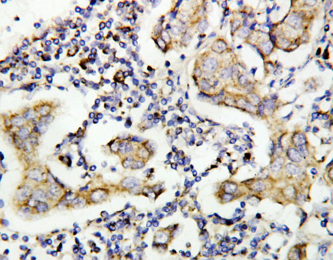 CASP8 / Caspase 8 Antibody - CASP8 / Caspase 8 antibody. IHC(P): Human Breast Cancer Tissue.