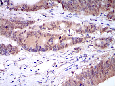 CASP8 / Caspase 8 Antibody - IHC of paraffin-embedded colon cancer tissues using CASP8 mouse monoclonal antibody with DAB staining.