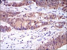 CASP8 / Caspase 8 Antibody - IHC of paraffin-embedded colon cancer tissues using CASP8 mouse monoclonal antibody with DAB staining.