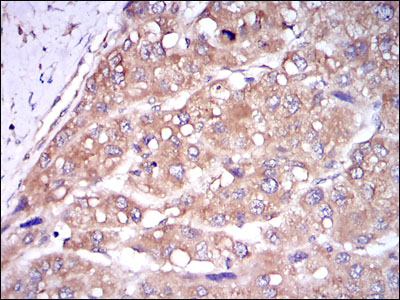 CASP8 / Caspase 8 Antibody - IHC of paraffin-embedded liver cancer tissues using CASP8 mouse monoclonal antibody with DAB staining.