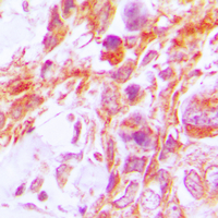 CASP8 / Caspase 8 Antibody - Immunohistochemical analysis of Caspase 8 staining in human lung cancer formalin fixed paraffin embedded tissue section. The section was pre-treated using heat mediated antigen retrieval with sodium citrate buffer (pH 6.0). The section was then incubated with the antibody at room temperature and detected using an HRP conjugated compact polymer system. DAB was used as the chromogen. The section was then counterstained with hematoxylin and mounted with DPX.