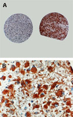 CASP8 / Caspase 8 Antibody - Formalin-fixed, paraffin-embedded sections from a brain tumor tissue array stained for Caspase-8 expression using Polyclonal Antibody to Active/Cleaved Caspase-8 at 1:2000. A. Anaplastic glioma (Grade III, left) and Gemistocytoma (Grade II, right) cores showing negative and positive staining for Caspase-8, respectively. B. Higher magnification of the Gemistocytoma tumor (from A).