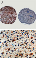 CASP8 / Caspase 8 Antibody - Formalin-fixed, paraffin-embedded sections from a brain tumor tissue array stained for Caspase-8 expression using Polyclonal Antibody to Caspase-8 (Pro and Active) at 1:2000. A. Anaplastic glioma cores from two different patients, positive (left) and negative (right) staining for caspase-8. B. Higher magnification from the caspase-8 positive (A, left) core.