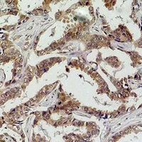 CASP8 / Caspase 8 Antibody - Immunohistochemical analysis of Caspase 8 staining in human breast cancer formalin fixed paraffin embedded tissue section. The section was pre-treated using heat mediated antigen retrieval with sodium citrate buffer (pH 6.0). The section was then incubated with the antibody at room temperature and detected using an HRP conjugated compact polymer system. DAB was used as the chromogen. The section was then counterstained with hematoxylin and mounted with DPX.