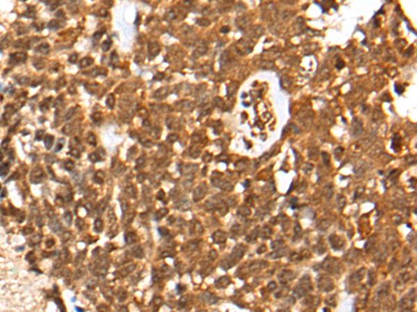 CASP8 / Caspase 8 Antibody - Immunohistochemistry of paraffin-embedded Human thyroid cancer tissue  using CASP8 Polyclonal Antibody at dilution of 1:35(×200)
