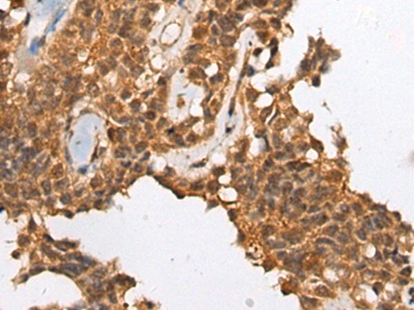 CASP8 / Caspase 8 Antibody - Immunohistochemistry of paraffin-embedded Human ovarian cancer tissue  using CASP8 Polyclonal Antibody at dilution of 1:35(×200)