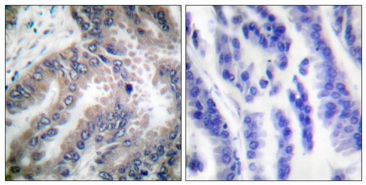 CASP8 / Caspase 8 Antibody - Peptide - + Immunohistochemical analysis of paraffin-embedded human lung carcinoma tissue using Caspase 8 (Ab-347) antibody.