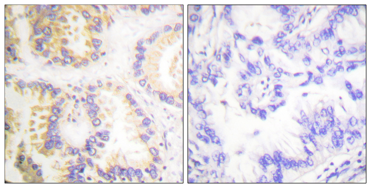 CASP8 / Caspase 8 Antibody - Immunohistochemistry analysis of paraffin-embedded human lung carcinoma, using Caspase 8 (Phospho-Ser347) Antibody. The picture on the right is blocked with the phospho peptide.