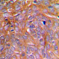 CASP8 / Caspase 8 Antibody - Immunohistochemical analysis of Caspase 8 (pS347) staining in human breast cancer formalin fixed paraffin embedded tissue section. The section was pre-treated using heat mediated antigen retrieval with sodium citrate buffer (pH 6.0). The section was then incubated with the antibody at room temperature and detected using an HRP conjugated compact polymer system. DAB was used as the chromogen. The section was then counterstained with hematoxylin and mounted with DPX.