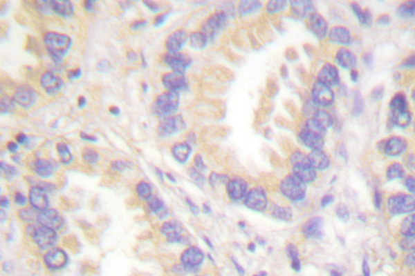 CASP8 / Caspase 8 Antibody - IHC of Caspase 8 (T341) pAb in paraffin-embedded human lung carcinoma tissue.