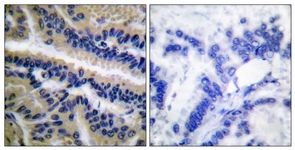 CASP9 / Caspase 9 Antibody - IHC of paraffin-embedded human lung carcinoma tissue, using Caspase 9 (Cleaved-Asp353) Antibody. The picture on the right is treated with the synthesized peptide.