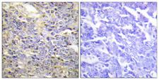 CASP9 / Caspase 9 Antibody - Immunohistochemistry analysis of paraffin-embedded human lung carcinoma tissue, using Caspase 9 Antibody. The picture on the right is blocked with the synthesized peptide.