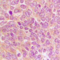 CASP9 / Caspase 9 Antibody - Immunohistochemical analysis of Caspase 9 p35 staining in human breast cancer formalin fixed paraffin embedded tissue section. The section was pre-treated using heat mediated antigen retrieval with sodium citrate buffer (pH 6.0). The section was then incubated with the antibody at room temperature and detected using an HRP-conjugated compact polymer system. DAB was used as the chromogen. The section was then counterstained with hematoxylin and mounted with DPX.