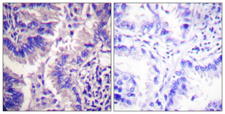 CASP9 / Caspase 9 Antibody - Cl-peptide - + Immunohistochemistry analysis of paraffin-embedded human lung carcinoma tissue using Caspase 9 (Cleaved-Asp315) antibody.