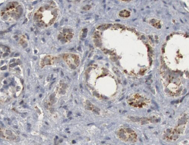 CASP9 / Caspase 9 Antibody - 1/100 staining human lung carcinoma by IHC-P. The sample was formaldehyde fixed and a heat mediated antigen retrieval step in citrate buffer was performed. The sample was then blocked and incubated with the antibody for 1.5 hours at 22°C. An HRP conjugated goat anti-rabbit antibody was used as the secondary antibody.