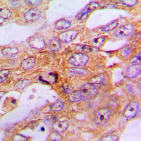 CASP9 / Caspase 9 Antibody - Immunohistochemical analysis of Caspase 9 staining in human lung cancer formalin fixed paraffin embedded tissue section. The section was pre-treated using heat mediated antigen retrieval with sodium citrate buffer (pH 6.0). The section was then incubated with the antibody at room temperature and detected using an HRP conjugated compact polymer system. DAB was used as the chromogen. The section was then counterstained with hematoxylin and mounted with DPX.