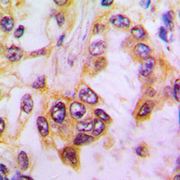 CASP9 / Caspase 9 Antibody - Immunohistochemical analysis of Caspase 9 staining in human lung cancer formalin fixed paraffin embedded tissue section. The section was pre-treated using heat mediated antigen retrieval with sodium citrate buffer (pH 6.0). The section was then incubated with the antibody at room temperature and detected using an HRP conjugated compact polymer system. DAB was used as the chromogen. The section was then counterstained with hematoxylin and mounted with DPX.