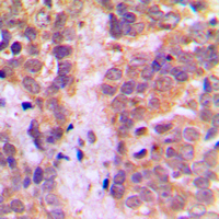 CASP9 / Caspase 9 Antibody - Immunohistochemical analysis of Caspase 9 staining in human breast cancer formalin fixed paraffin embedded tissue section. The section was pre-treated using heat mediated antigen retrieval with sodium citrate buffer (pH 6.0). The section was then incubated with the antibody at room temperature and detected using an HRP conjugated compact polymer system. DAB was used as the chromogen. The section was then counterstained with hematoxylin and mounted with DPX.