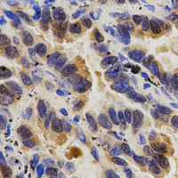 CASP9 / Caspase 9 Antibody - Immunohistochemical analysis of Caspase 9 p35 staining in human lung cancer formalin fixed paraffin embedded tissue section. The section was pre-treated using heat mediated antigen retrieval with sodium citrate buffer (pH 6.0). The section was then incubated with the antibody at room temperature and detected using an HRP polymer system. DAB was used as the chromogen. The section was then counterstained with hematoxylin and mounted with DPX.