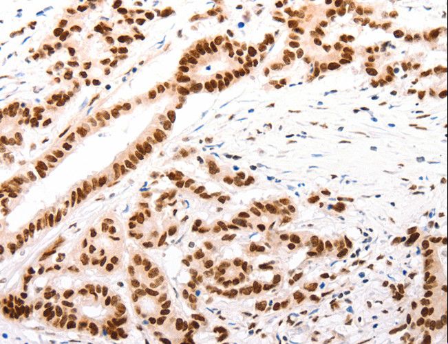 CASP9 / Caspase 9 Antibody - Immunohistochemistry of paraffin-embedded Human lung cancer using CASP9 (active) Polyclonal Antibody at dilution of 1:80.