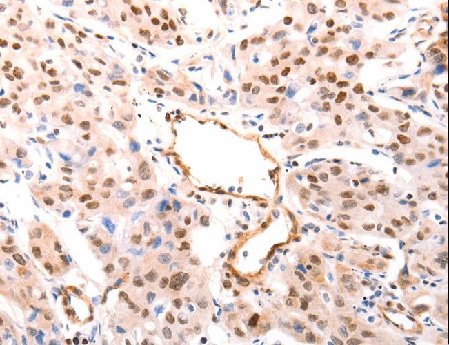 CASP9 / Caspase 9 Antibody - Immunohistochemistry of paraffin-embedded Human lung cancer using CASP9 (active) Polyclonal Antibody at dilution of 1:80.