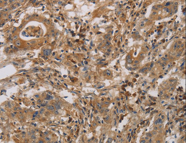 CASP9 / Caspase 9 Antibody - Immunohistochemistry of paraffin-embedded Human gastric cancer using CASP9 Polyclonal Antibody at dilution of 1:70.