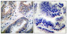 CASP9 / Caspase 9 Antibody - Peptide - + Immunohistochemical analysis of paraffin-embedded human lung carcinoma tissue using Caspase 9 (Ab-125) antibody.